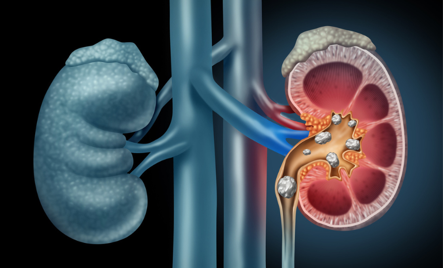 urinary tract calculi